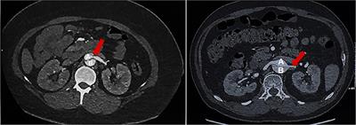 Short Term Prognosis of Renal Artery Stenosis Secondary to Acute Type B Aortic Dissection With TEVAR